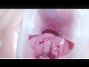 少女用扩阴器展示自己的阴道和宫颈